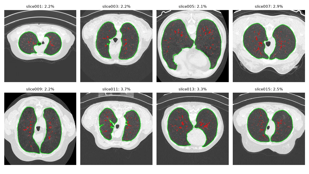 Eight of the 21 segmentations. Slices 010, 012, 020 and 021 contain dense regions inside the lungs, which is what pushes their ratio up.