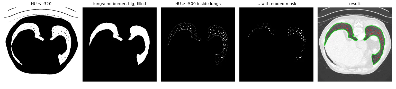 Air below −320 HU; the lungs (no border contact, large, filled); dense pixels inside them — the wall is included; with the eroded mask, only vessels remain; final overlay.