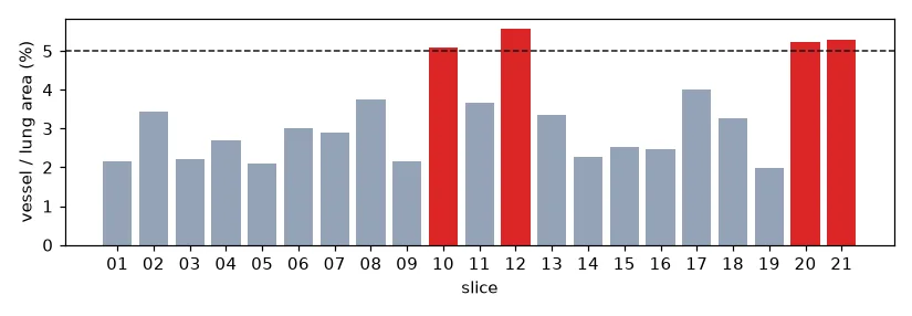 Vessel-to-lung area ratio per slice. Four slices reach the (arbitrary) 5% threshold.